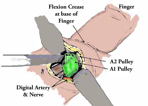 Diagram of the Surgical Procedure